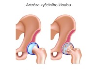 Artritida