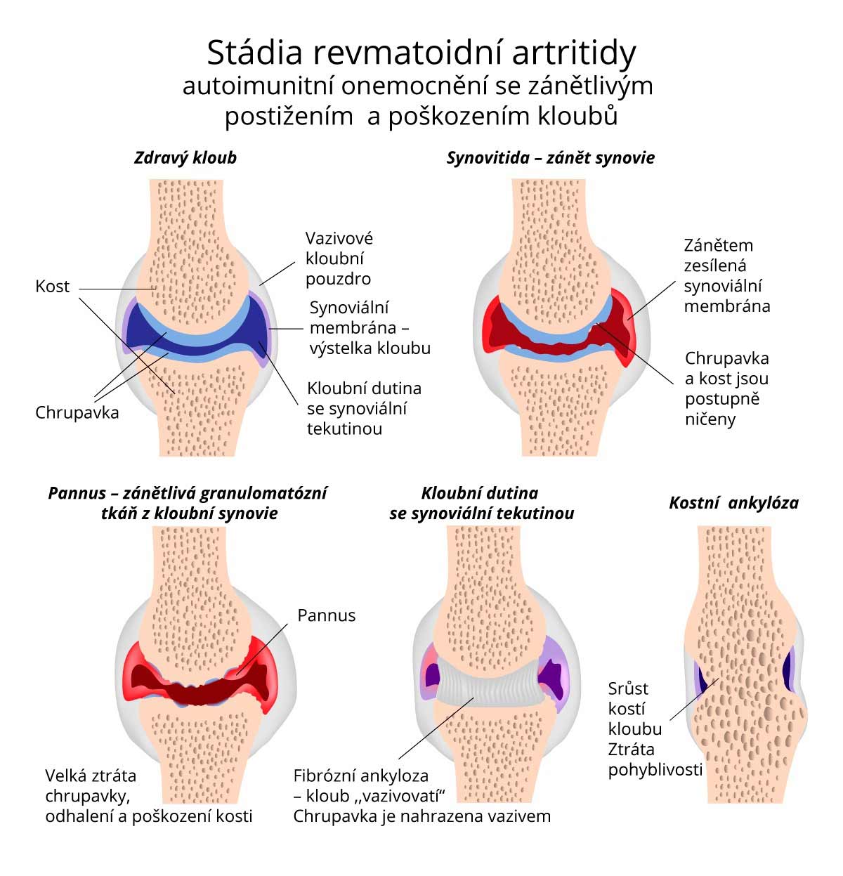 Co se děje s klouby při revmatické artritidě